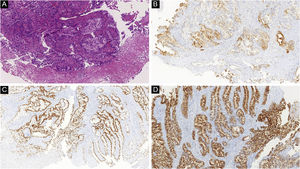 (A) Proliferação nodular atípica na derme profunda em paciente com metástase cutânea de adenocarcinoma de cólon (Hematoxilina & eosina, 100×). CK7 (B) CDX2 (C) e EMA (D) positivos corroboram o diagnóstico