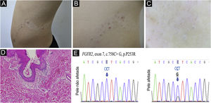 (A) Nevo acneiforme sobre mancha hipopigmentada, seguindo a linha de Blaschko. (B) Comedões em detalhe, pápulas e nódulos inflamatórios. (C) Tampão folicular, pelos enrolados e hipomelanose no centro do folículo na dermatoscopia (aumento original de 10×). (D) Infundíbulo folicular dilatado e obstruído e infiltrado linfo‐histiocitário perifolicular (Hematoxilina & eosina, 100×). (E) Sequência de DNA do gene FGFR2 do nevo acneiforme e pele contralateral não afetada do paciente é mostrada. A mutação somática em heterozigose é indicada pela seta
