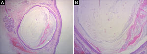 Achados microscópicos. (A) e (B) Histopatologia de biopsia da região bucinadora mostrando um cisto intradérmico com abundante queratina lamelar e vários pelos velos dentro do cisto (Hematoxilina & eosina, 10×e 40×)