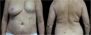 Imagem clínica. Paciente do sexo feminino com sete melanomas primários extirpados entre 2006 e 2020