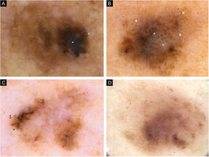 (A) Imagens dermatoscópicas de sete melanomas primários individuais. 2006, melanoma de 0,6mm, extremidade superior. Lesão caótica, rede pigmentar residual, área hiperpigmentada excêntrica com véu cinza‐azulado (*) e glóbulos pigmentados (^) na periferia. (B) Imagens dermatoscópicas de sete melanomas primários individuais. 2008, melanoma de 0,8mm, extremidade superior. Lesão caótica, áreas de regressão com estruturas branco‐azuladas (*) e pontos acinzentados (peppering, #). (C) Imagens dermatoscópicas de sete melanomas primários individuais. 2011, melanoma in situ, tronco. Lesão caótica, hipopigmentação central, rede pigmentar residual. Estrias radiadas ($) e pontos pigmentados na periferia (>). (D) Imagens dermatoscópicas de sete melanomas primários individuais. 2017, melanoma de 0,5mm, tronco. Lesão caótica, principalmente áreas sem estrutura, áreas multifocais de hiperpigmentação, vasos com padrão pontilhado (<)