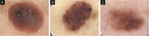 (A) Imagens dermatoscópicas de sete melanomas primários individuais. 2018, melanoma de 1,0mm, extremidade inferior. Principalmente áreas sem estrutura, centrais Estruturas azul‐esbranquiçadas, periféricas (*) e pontos pigmentados, de cor rosa (>). (B) Imagens dermatoscópicas de sete melanomas primários individuais. 2019, melanoma de 0,3mm em extremidade inferior. Lesão caótica, áreas sem estrutura, estrias radiadas ($), glóbulos pigmentados na periferia (^) e véu azul‐acinzentado central (*). (C) Imagens dermatoscópicas de sete melanomas primários individuais. 2020, melanoma de 0,1mm, no tronco. Lesão caótica com áreas hiperpigmentadas (&) e rede pigmentar acentuada. O seguimento dermatoscópico digital e as imagens de corpo inteiro foram úteis em algumas decisões sobre a excisão dos melanomas finos