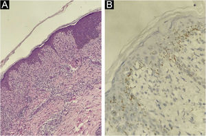 (A) Histopatologia da pele na coloração pela Hematoxilina & eosina, 400×, mostrando infiltrado linfocítico e histiocitário inespecífico com alguns plasmócitos. (B) Avaliação imuno‐histoquímica (400×) para Treponema pallidum mostrando a presença de espiroquetas