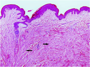 Neoplasia mesenquimal de células fusiformes localizada na derme, composta por células alongadas de citoplasma eosinofílico distribuídas irregularmente (setas). A neoplasia é adjacente ao folículo piloso (Hematoxilina & eosina, 40×)