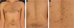 Pápulas eritemato‐acastanhadas acometendo membros superiores e tronco (A e B) e em maior aumento (C)