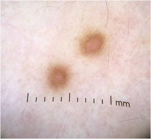 Dermatoscopia evidenciando rede periférica com área homogênea rósea central