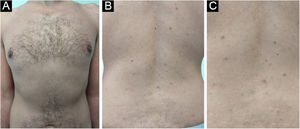 Diminuição do número, pigmentação e tamanho das lesões após um ano na região torácica anterior (A) e dorso (B e C)