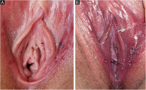 Progressão da aftose vulvar. (A) Apresentação clínica inicial, com ulcerações milimétricas, rasas, vermelho‐púrpura. (B) Dia 1 do seguimento. Grandes e pequenos lábios com edema e eritema. Ulcerações com centro purulento