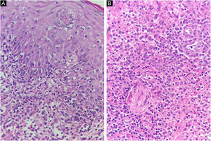 Histopatologia de uma úlcera corada com Hematoxilina & eosina. (A) Ulceração e espongiose da mucosa vulvar. (B) Denso infiltrado inflamatório misto contendo linfócitos, histiócitos e escassos monócitos no tecido subepitelial