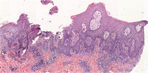 A histopatologia de uma das lesões revelou células névicas agrupadas em pequenos ninhos com maturação adequada, sem sinais de displasia, circundadas por infiltrado inflamatório predominantemente linfocítico e espongiose acentuada (Hematoxilina & eosina, original 50×)