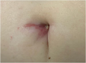 Mancha violácea única com fino padrão reticulado de pontos e linhas (estrias de Wickham) na cicatriz umbilical