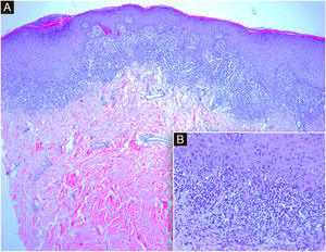 (A) Cortes histológicos mostram epiderme com hiperceratose ortoceratótica e paraceratose focal, acantose com hipergranulose e denso infiltrado inflamatório subepidérmico em faixa consistente com dermatite de interface (Hematoxilina & eosina, 4×). (B) No detalhe observa‐se dermatite de interface linfocítica com degeneração vacuolar da camada basal e queratinócitos necróticos na epiderme (Hematoxilina & eosina, 20×)