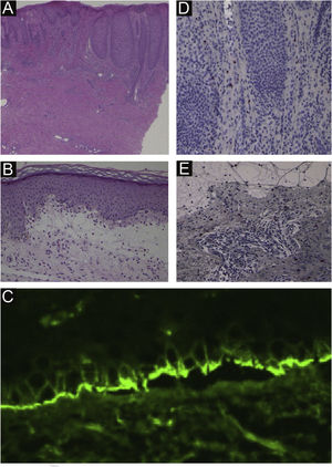 (A) Aspecto histopatológico do prurigo nodular mostrando acantose irregular da epiderme, infiltrado de células inflamatórias na derme superior e fibrose na derme (40×). (B) Histopatologia da lesão bolhosa mostrando bolha subepidérmica com infiltração de eosinófilos (100×). (C) Imunofluorescência direta mostrando deposição linear de IgG na zona da membrana basal. (D) Imunomarcação com BB‐1 na pele lesional do prurigo nodular (200×). (E) Imunomarcação com BB‐1 na pele lesional do penfigoide bolhoso (200×).