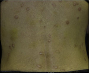 Acentuada melhora das lesões nodulares após dois anos.