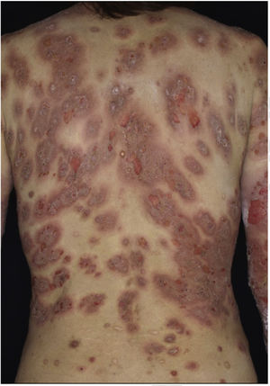 Lesões bolhosas e eritematosas no tronco.