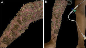 Crostas espessas de aspecto vegetante sobre placa eritematosa ocupando todo o membro inferior direito (A – B)