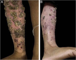 Regressão parcial das lesões cutâneas. (A) Aspecto do membro inferior direito antes do tratamento. (B) Membro inferior direito, quatro semanas depois do início de fluconazol