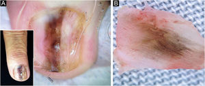 Melanoníquia longitudinal da placa ungueal: (A) Onicodistrofia associada a pigmentação irregular e heterogênea em faixa de 3mm de largura no terceiro quirodáctilo esquerdo. Dermatoscopia da lâmina com linhas longitudinais irregulares marrom‐claras e escuras, pretas e cinzas (detalhe). (B) Dermatoscopia intraoperatória mostrando variação na pigmentação (marrom, cinza e preto) nas linhas discretamente irregulares