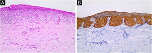 Achados da histopatologia e imuno‐histoquímica. (A) Lesão intraepidérmica com proliferação de queratinócitos atípicos com perda de polaridade (Hematoxilina & eosina, 200×). (B) Positividade da imuno‐histoquímica para AE1/AE3 (Pan‐citoqueratina, 200×)