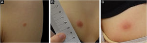 Aspecto clínico das lesões. Nódulos eritematosos na região deltoidea esquerda (A); peitoral direita (B) e abdominal direita (C)