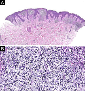 (A) Infiltrado denso e difuso preenchendo a derme papilar, sem epidermotropismo proeminente (Hematoxilina & eosina, 20×). (B) Células linfoides de tamanho pequeno a médio, com discreto pleomorfismo (Hematoxilina & eosina, 200×)