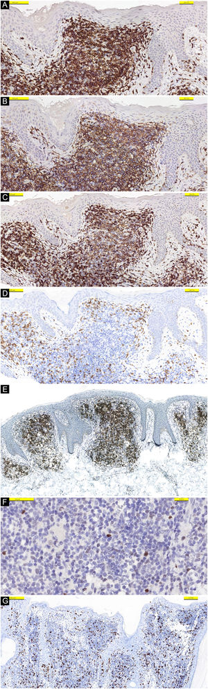 Células linfoides expressando CD3 (A), CD4 (B), CD7 (C), mas negativas para CD8 (D). (E) Imunomarcação forte com PD‐1. (F) Imunomarcação fraca com Bcl‐6. (G) Ativação de Ki‐67