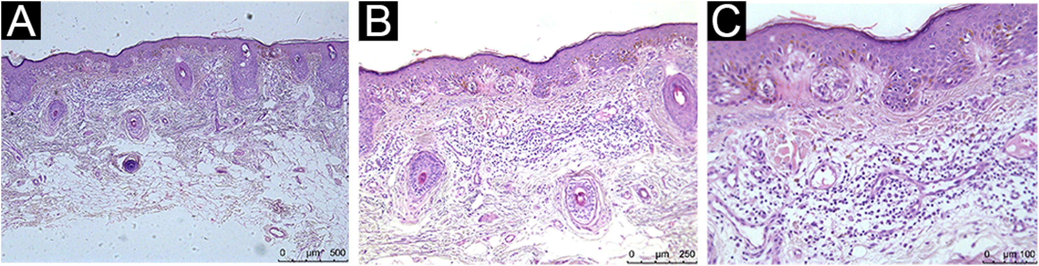 Infiltrado inflamatório tumoral não prediz metástases em melanomas ...