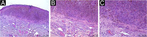 Histopatológico evidenciando infiltrado inflamatório peritumoral leve. Hematoxilina & eosina. (A), Aumento de 4×. (B), Aumento de 10×. (C), Aumento de 20×