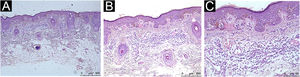 Histopatológico evidenciando infiltrado inflamatório peritumoral moderado. Hematoxilina & eosina, (A), Aumento de 4×. (B), Aumento de 10×. (C), Aumento de 20×