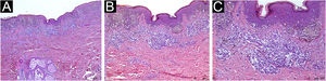 Histopatológico evidenciando infiltrado inflamatório tumoral marcado. Hematoxilina & eosina. (A), Aumento de 4×. (B), Aumento de 10×. (C), Aumento de 20×