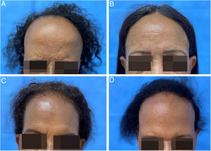 (A‐D) Apresentação clínica das quatro irmãs acometidas por alopécia frontal fibrosante (AFF)