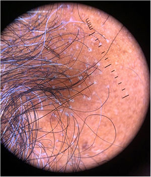Tricoscopia de uma das pacientes corroborando o diagnóstico. Descamação peripilar, unidades foliculares com apenas um pelo emergente, inexistência de orifícios foliculares, ausência de fios velus e fundo branco‐marfim com tonalidade eritematosa na área de fibrose. Todas pacientes apresentavam padrão semelhante