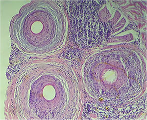 Exame histopatológico de couro cabeludo, folículo piloso (istmo), Hematoxilina & eosina, 100×. Alopecia cicatricial com fibrose concêntrica perifolicular, agressão linfocítica ao epitélio folicular e presença de corpos apoptóticos. A região do infundíbulo e do bulbo não apresentava inflamação