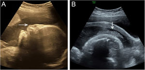 (A) Ultrassonografia em 2D: a face fetal mostra curva plana e hipoplasia nasal (seta) no corte sagital mediano. (B) Ultrassonografia em 2D: aspecto anormal da pele, em flocos (seta)