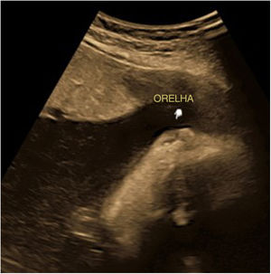 Ultrassonografia em 2D: microtia (seta)