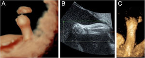 (A) Ultrassonografia em 3D: punhos cerrados e edema cutâneo. (B) Ultrassonografia em 2D: encurtamento das falanges e metacarpos. (C) Ultrassonografia em 3D: imagem do membro superior do feto