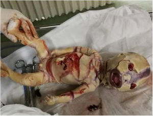 Aparência do feto abortado com ictiose arlequim foi consistente com o diagnóstico ultrassonográfico pré‐natal