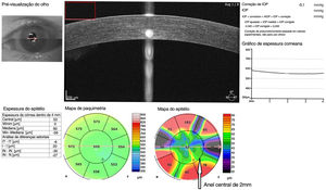 Mapeamento da espessura epitelial corneana média com SD‐OCT. Anel de zona central de 2mm indicado pela seta branca. Espessura epitelial corneana média na zona central de 2mm, utilizada na análise das medidas. Unidade: μm