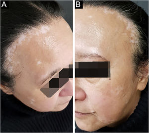Achados clínicos da paciente 1. (A) Rarefação capilar na região frontal do couro cabeludo, coexistindo com máculas acrômicas de vitiligo. (B) Rarefação das sobrancelhas em mácula crescente de vitiligo
