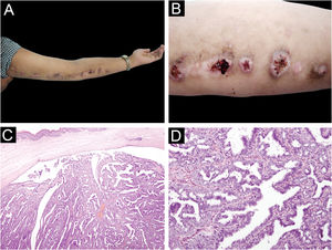 (A,B) Várias pápulas normocrômicas, algumas com superfície verrucosa, com diâmetro entre 1 e 2,5cm no membro superior esquerdo, dispostas em padrão linear. (C) Tumor localizado na derme superficial sem conexão com a epiderme sobrejacente, composto por estruturas semelhantes a cistadenomas e estruturas papilíferas pregueadas (Hematoxilina & eosina, 40×). (D) Os espaços císticos e as estruturas papilíferas são revestidos por epitélio colunar de camada única e circundados por uma camada de pequenas células mioepiteliais cuboidais, formando uma estrutura especial de dupla camada. (Hematoxilina & eosina, 400×)