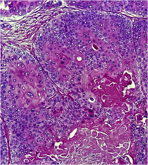 Células escamosas com núcleos atípicos, porém sem mitoses e com queratinização abrupta (de tipo triquilemal). (Hematoxilina & eosina, 400×)