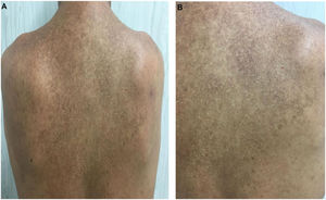 (A) Região dorsal, quatro meses após início do tratamento. (B) Detalhe do dorso, região escapular direita após tratamento