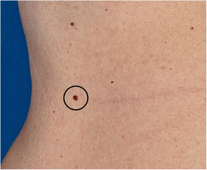 Pápula acastanhada medindo aproximadamente 0,8cm, séssil