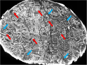 Microscopia confocal in vivo, mosaico: presença de cordões e ilhas de células tumorais (setas vermelhas), formando anastomoses, circundadas por estroma fibroso (setas azuis)