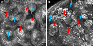 (A e B) Microscopia confocal in vivo: ilhas e cordões de células tumorais com periferia em paliçada (setas vermelhas) formando anastomoses, circundadas por estroma fibroso (setas azuis)