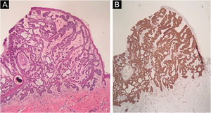 (A) Histopatologia da lesão apresenta cordões de células tumorais em paliçada na periferia (Hematoxocilina & eosina, 40×). (B) Imuno‐histoquímica demonstra a expressão do marcador BER‐EP4, evidenciando os cordões de células tumorais (40×)