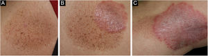 (A) Várias pequenas manchas lentiginosas acastanhadas apareceram após a melhora da psoríase. (B) Placas psoriásicas foram observadas em parte da mácula pigmentar. (C) A psoríase ocorreu dentro da mácula pigmentar e se espalhou além dela