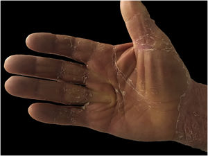 Imagem clínica de ceratodermia palmar