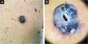 Caso 1. (A) Tumor exofítico intensamente pigmentado, com centro ulcerado na região lombar. (B) A dermatoscopia mostra padrão homogêneo azul‐violeta, véu azul‐acinzentado e ulceração central