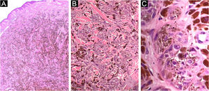 Caso 1. (A) Neoplasia melanocítica dérmica, com grande quantidade de pigmento e epiderme preservada (Hematoxilina & eosina, 2×). (B) Ninhos de melanócitos atípicos entremeados por numerosos melanófagos e feixes de colágeno (Hematoxilina & eosina, 10×). (C) Melanócitos epitelioides e fusiformes, com atipia acentuada e nucléolos volumosos (Hematoxilina & eosina, 40×)